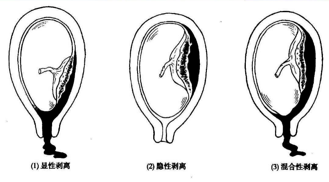 怀女孩第一个月的症状，揭秘早期迹象